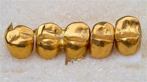 How Much is Your Dental Gold Really Worth? | KOMO