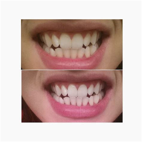 Simply Skincare : Activated Charcoal Teeth Whitening!