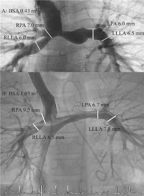 Pulmonary Angiogram Anatomy