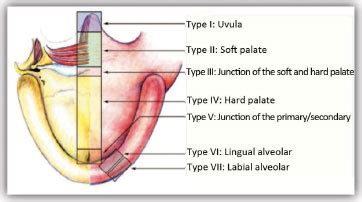 RBCP - Speech resonance and surgical complications after primary palatoplasty with intravelar ...