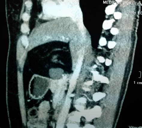 VIETNAMESE MEDIC ULTRASOUND: CASE 358: LESSER OMENTUM TUMOR, Dr PHAN THANH HAI , Dr VAN UYEN ...