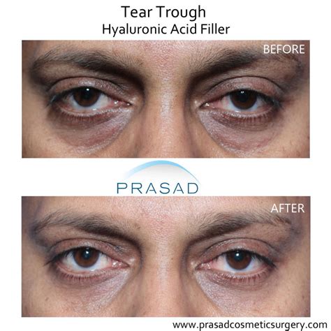 Under Eye Filler for Hollow Eyes, Tear Troughs and Under Eye Bags