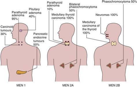 Multiple endocrine neoplasia | Basicmedical Key