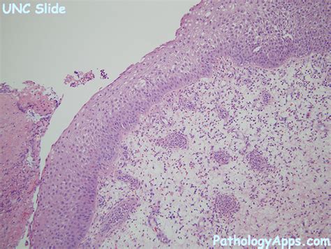 sinonasal polyp pathology