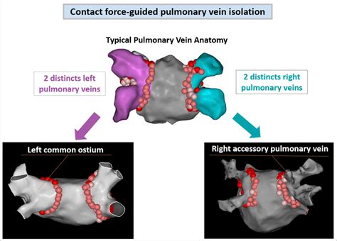 Posterior view of the left atrium in the 3 types of pulmonary vein... | Download Scientific Diagram