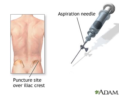 Bone marrow biopsy | UF Health, University of Florida Health