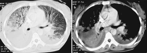 Eosinophilic Pneumonia | Thoracic Key