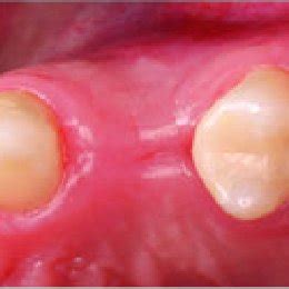 Case 3: Presurgical view (incisal). Ridge appears to be very flat and... | Download Scientific ...