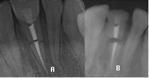 Fig. (4). Rx follow-up: Root fracture line widening A ) 12 months follow-up B ) 36 months follow-up.