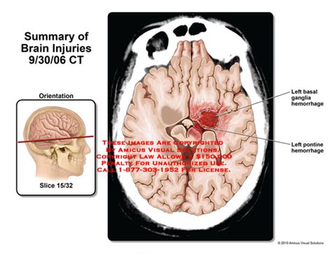 AMICUS Illustration of amicus,injury,brain,CT,basal,ganglia,hemorrhage,pontine