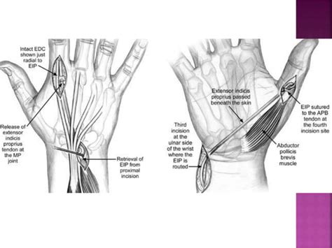 Ape thumb deformity to publish | PPT