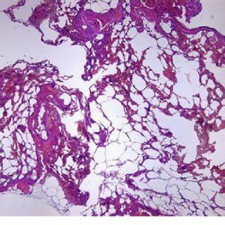 (PDF) Spinal extradural angiolipoma: Report of two cases and review of ...