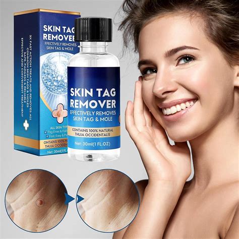 Anti-wart Liquid Nitrogen, Skin Tags Effective Treatment, 30ml Skin Tag ...