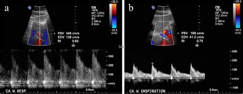 (A) Abdominal ultrasound Doppler showed a patent celiac artery with... | Download Scientific Diagram