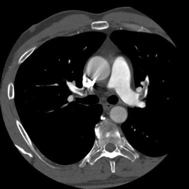 Pulmonary Embolism CT Imaging and Diagnosis: Practice Essentials ...