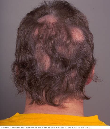 Nutrafol and Hair Loss - Alamo Heights Dermatology