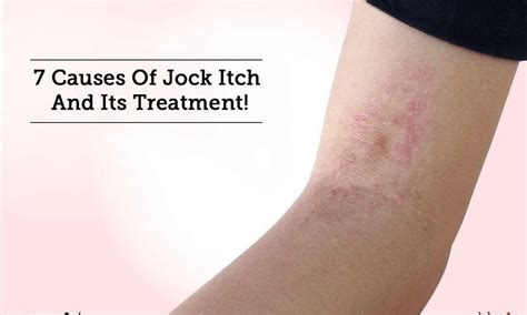 Jock Itch (Tinea Cruris) In Kids: Causes, Remedies, 40% OFF