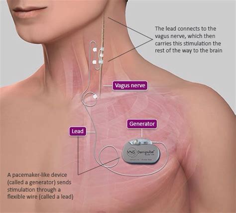VNS Therapy implant my son just got! | Nerf vague, Les nerfs, Nerf
