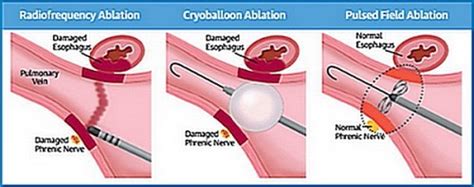 2020 AF Symposium: Pulsed Field Ablation—Emerging Tech for Atrial ...