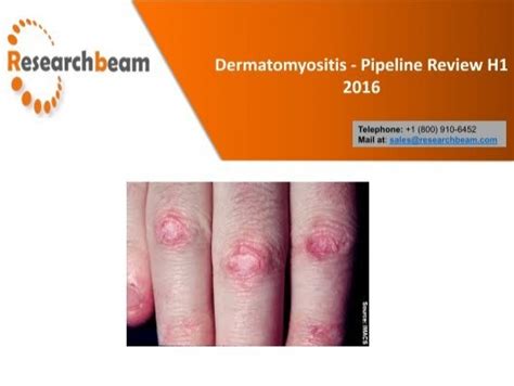 Dermatomyositis Causes and Symptoms – Overview