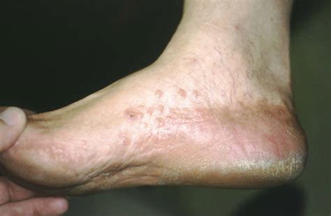 psoriasis sole foot - The Skin and Wellness Center