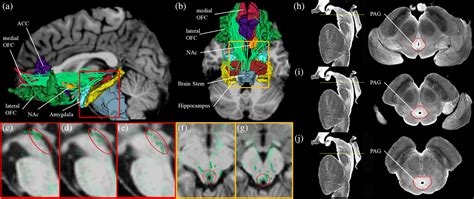 Microstructural alterations in medial forebrain bundle are associated ...