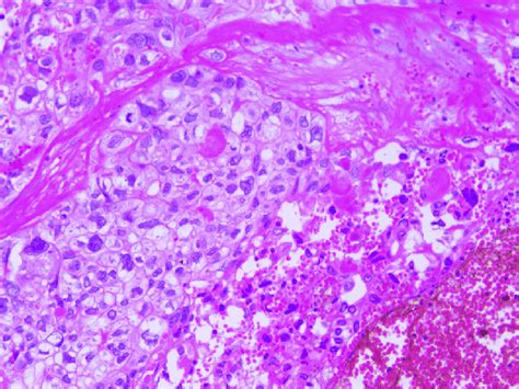 e Microscopic findings: syncytiotrophoblast and cytotrophoblast amidst ...