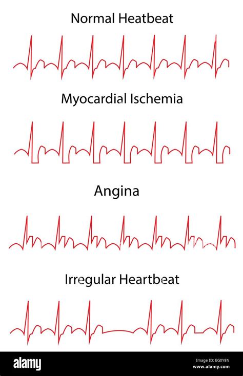ECG EKG Heart Disease Stock Vector Image & Art - Alamy