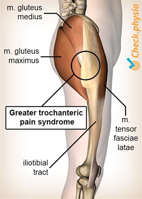 Greater trochanteric pain syndrome | Physio Check