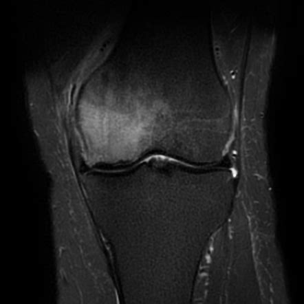 Subchondral insufficiency fracture of the knee | Radiology Case | Radiopaedia.org