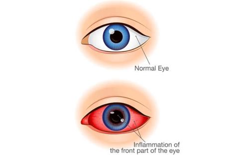 What Is Uveitis, What Causes Uveitis, Uveitis Symptoms, 44% OFF