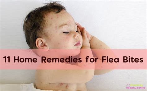 Flea Bites: 11 Effective Home Remedies for Kids | Flea remedies, Home remedies for fleas, Flea bite