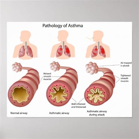 Lung disease Asthma Poster | Zazzle.com