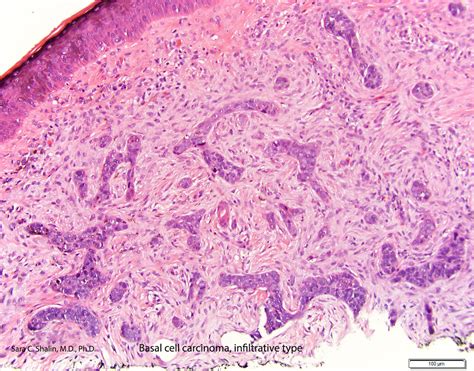 infiltrative basal cell carcinoma - pictures, photos