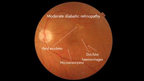 Diabetic retinopathy