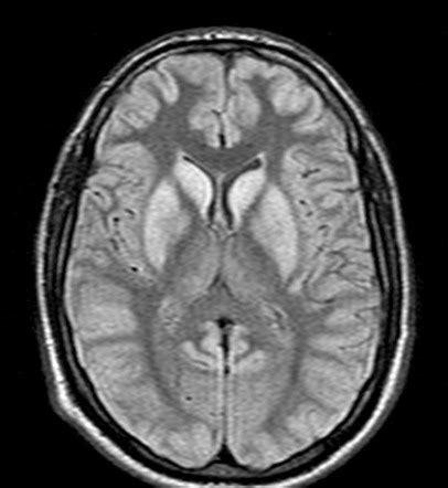 Hypoglycemic encephalopathy | Radiology Reference Article | Radiopaedia.org