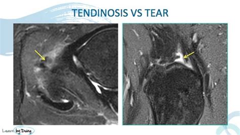 Hip MRI Gluteal Tendon Abnormalities - Radedasia