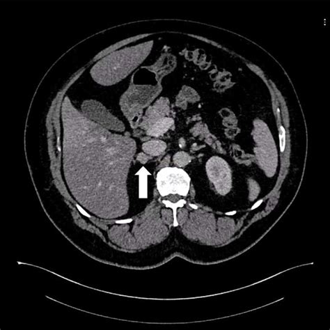 Omentopexy after gastrectomy. | Download Scientific Diagram