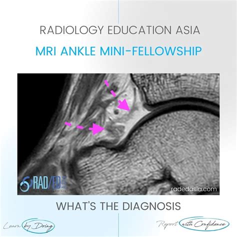 ANKLE SYNOVITIS MRI RADIOLOGY - Radedasia