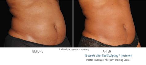 CoolSculpting Before and after Images |Results of Real Patients