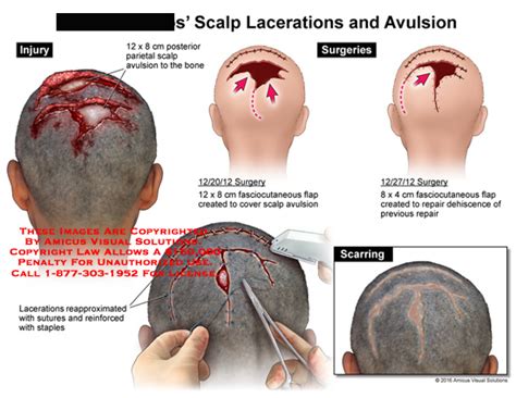 Stapled head wound - virtenterprise