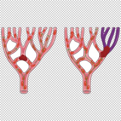 Thrombus position and consequences vector scientific illustration