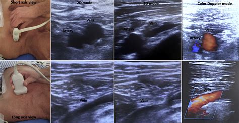 Axillary vein puncture guided by ultrasound vs cephalic vein dissection in pacemaker and ...