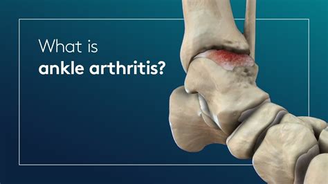 What is ankle arthritis? - YouTube