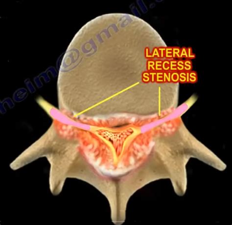 Lumbar Spinal Stenosis – Nabil Ebraheim – Medium