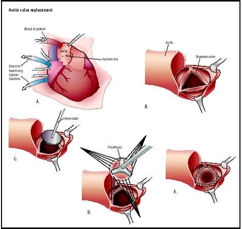 Heart Valve: Open Heart Valve Replacement Surgery Recovery