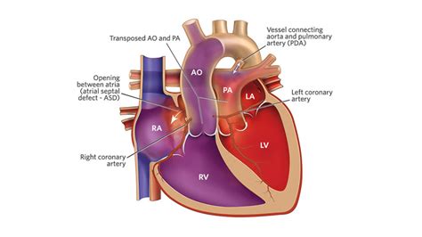 Congenital Heart Defects Dextro-Transposition Of The Great, 41% OFF