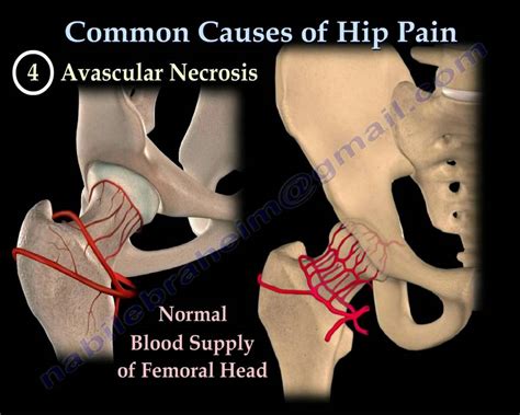 Arthritis Symptoms: Arthritis In Hip Joint Symptoms