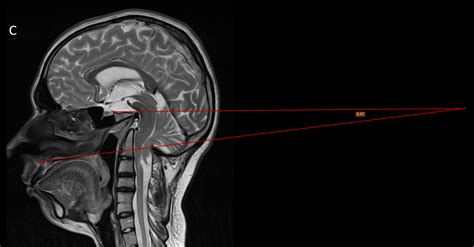 Platybasia and basilar invagination | Image | Radiopaedia.org