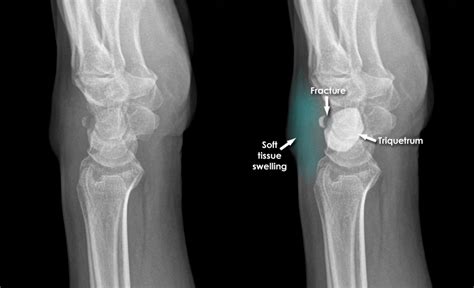 Trauma X-ray - Upper limb gallery 2 - Wrist - Triquetrum fracture